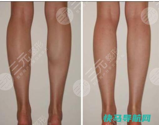 医美瘦小腿的方法