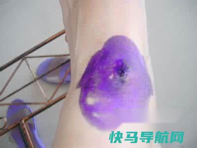 手上长鸡眼根除 第3张